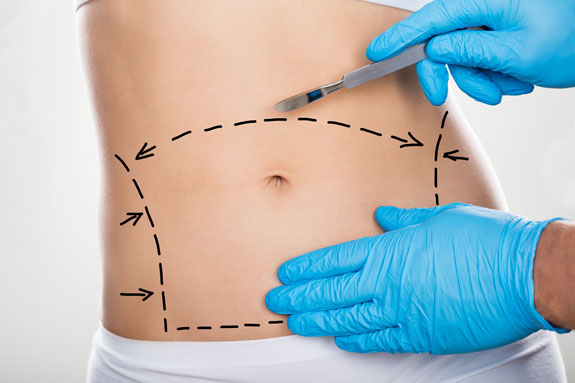 Abdominoplastik Bad Kreuznach